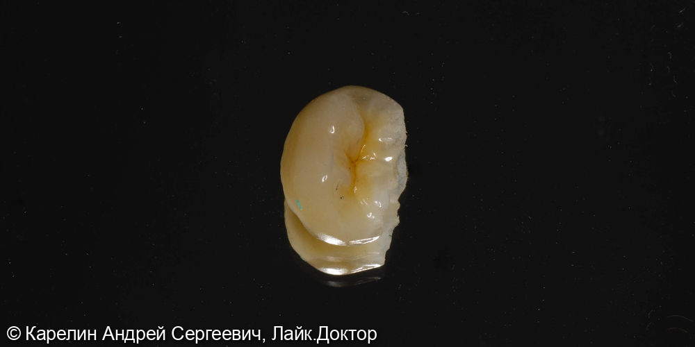 Ортопедическая реставрация зуба 3.6 - фото №3