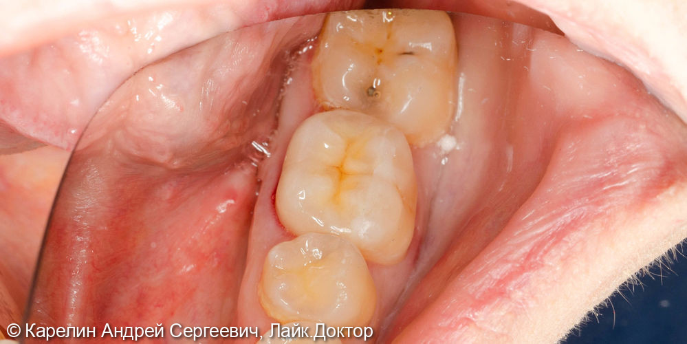 Ортопедическая реставрация зуба 3.6 - фото №4