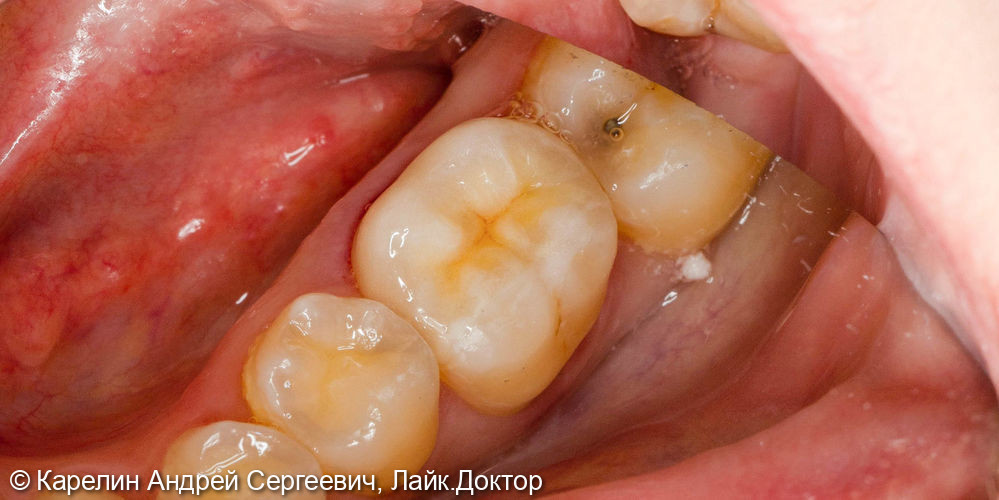 Ортопедическая реставрация зуба 3.6 - фото №5