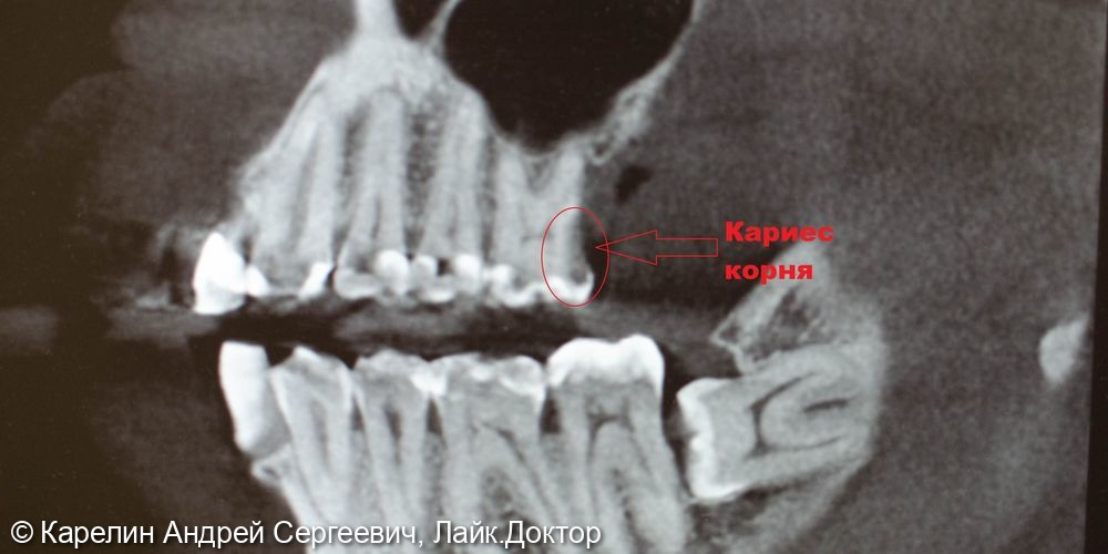 Накладка E.max на зуб 1.6 - фото №3