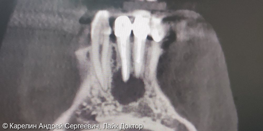 Лечение обострения хронического гранулематозного периодонтита 4.2 и 4.1 зубов - фото №1