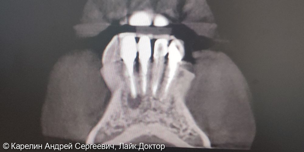 Лечение обострения хронического гранулематозного периодонтита 4.2 и 4.1 зубов - фото №4