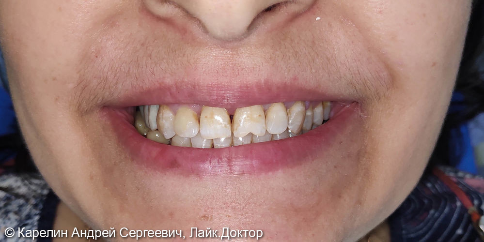 Восстановление прикуса с помощью металлокерамических коронок на зубах и имплантатах - фото №1