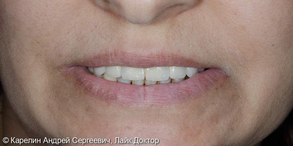 Восстановление прикуса с помощью металлокерамических коронок на зубах и имплантатах - фото №13