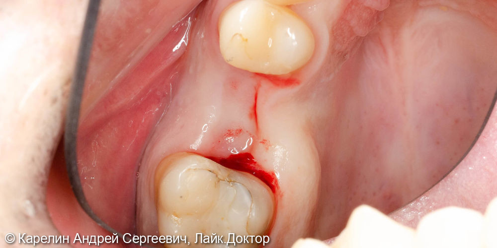 Импланация и протезирование зуба 2.6 - фото №1