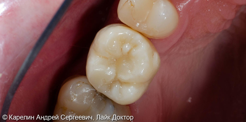 Импланация и протезирование зуба 2.6 - фото №9