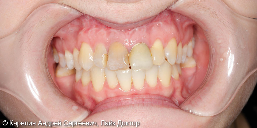 Одномоментная с удалением имплантация 1.2 и 2.1 зуба, изготовление временных конструкций в это же посещение - фото №1