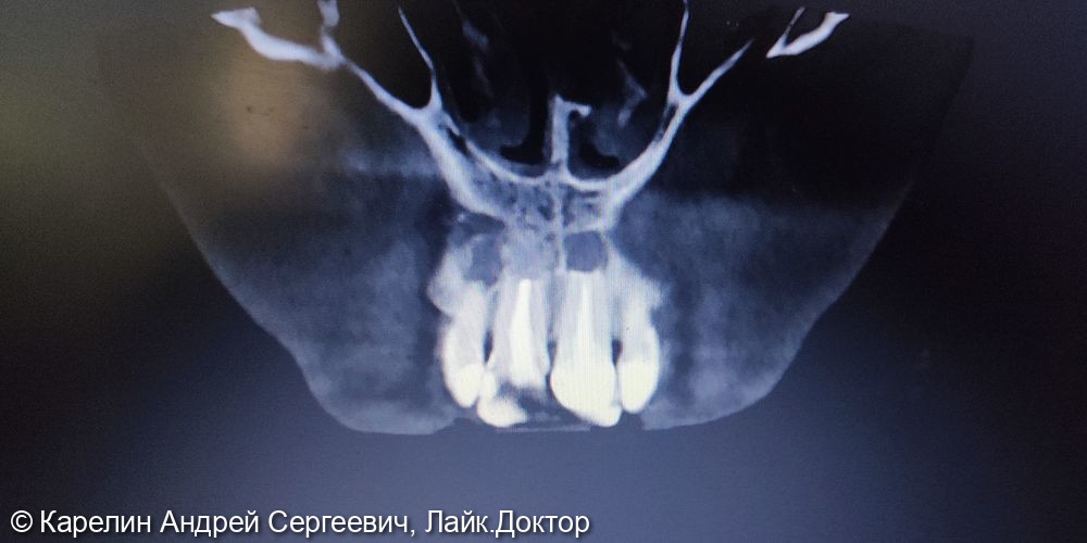 Одномоментная с удалением имплантация 1.2 и 2.1 зуба, изготовление временных конструкций в это же посещение - фото №2