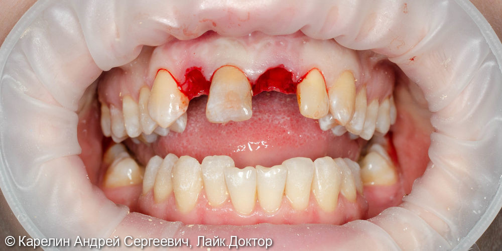 Одномоментная с удалением имплантация 1.2 и 2.1 зуба, изготовление временных конструкций в это же посещение - фото №4