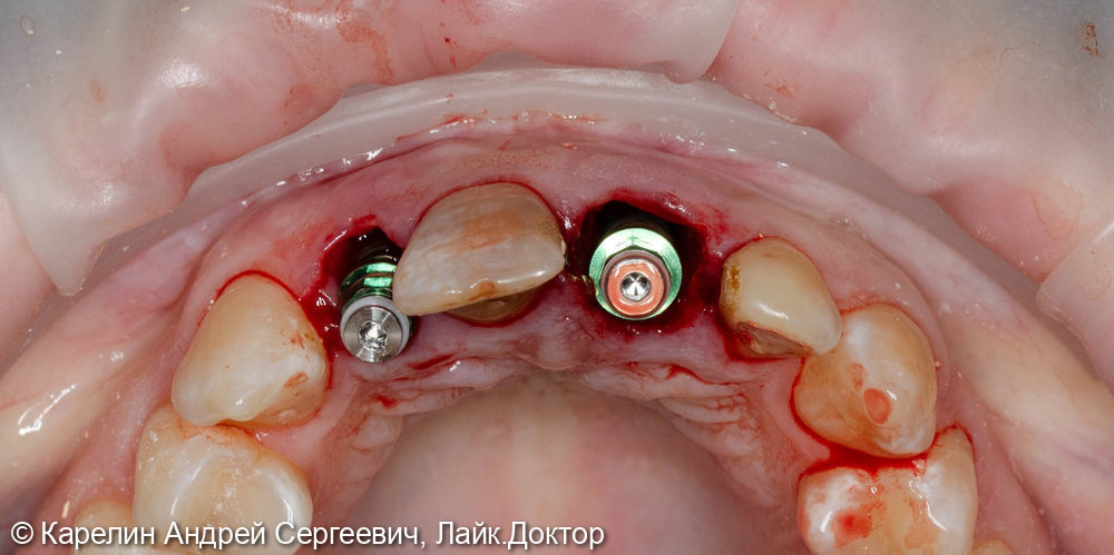 Одномоментная с удалением имплантация 1.2 и 2.1 зуба, изготовление временных конструкций в это же посещение - фото №6