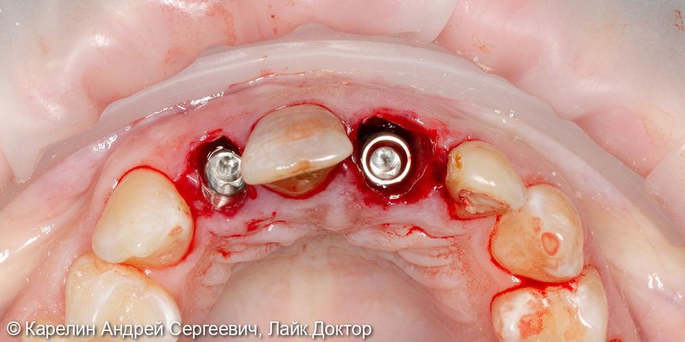 Одномоментная с удалением имплантация 1.2 и 2.1 зуба, изготовление временных конструкций в это же посещение - фото №8