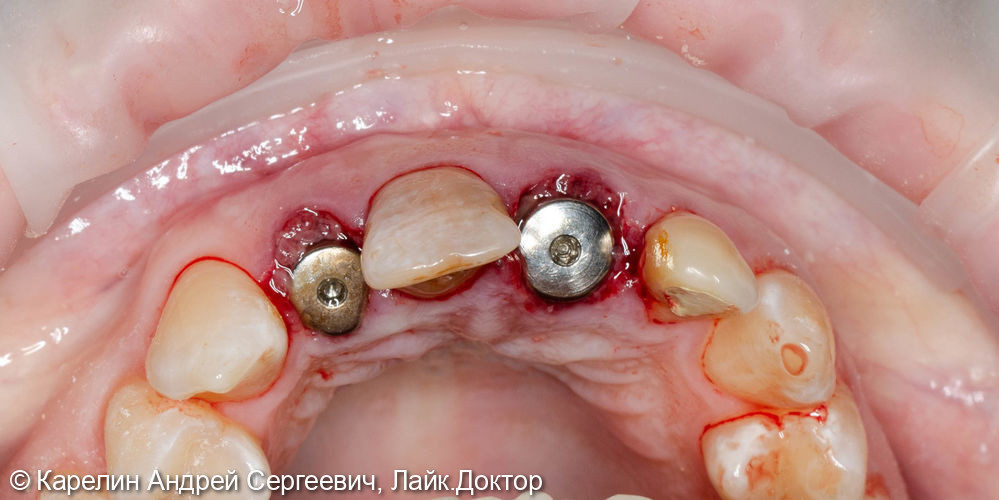 Одномоментная с удалением имплантация 1.2 и 2.1 зуба, изготовление временных конструкций в это же посещение - фото №9