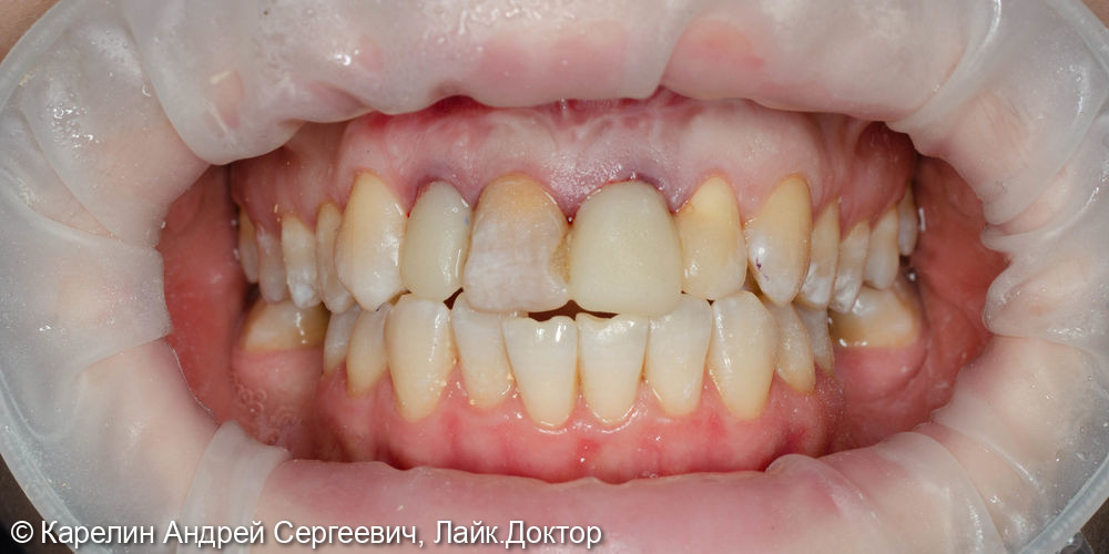 Одномоментная с удалением имплантация 1.2 и 2.1 зуба, изготовление временных конструкций в это же посещение - фото №11