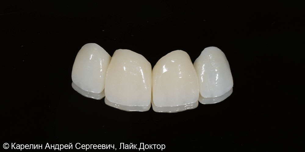 Эстетическая реставрация 4 верхних резцов верхней челюсти Винирами E.max - фото №5