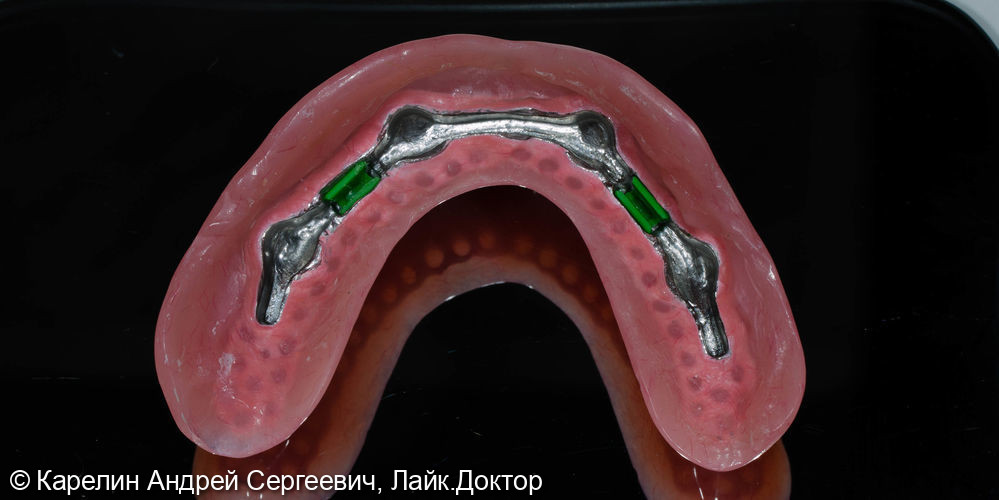 Протезирование при полном вторичном отсутствии зубов на верхней челюсти с помощью бюгельного протеза на имплантатах - фото №4