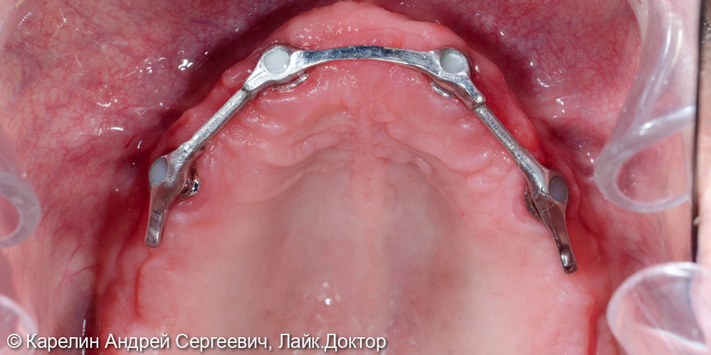 Протезирование при полном вторичном отсутствии зубов на верхней челюсти с помощью бюгельного протеза на имплантатах - фото №5