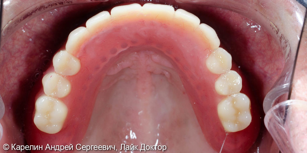 Протезирование при полном вторичном отсутствии зубов на верхней челюсти с помощью бюгельного протеза на имплантатах - фото №6