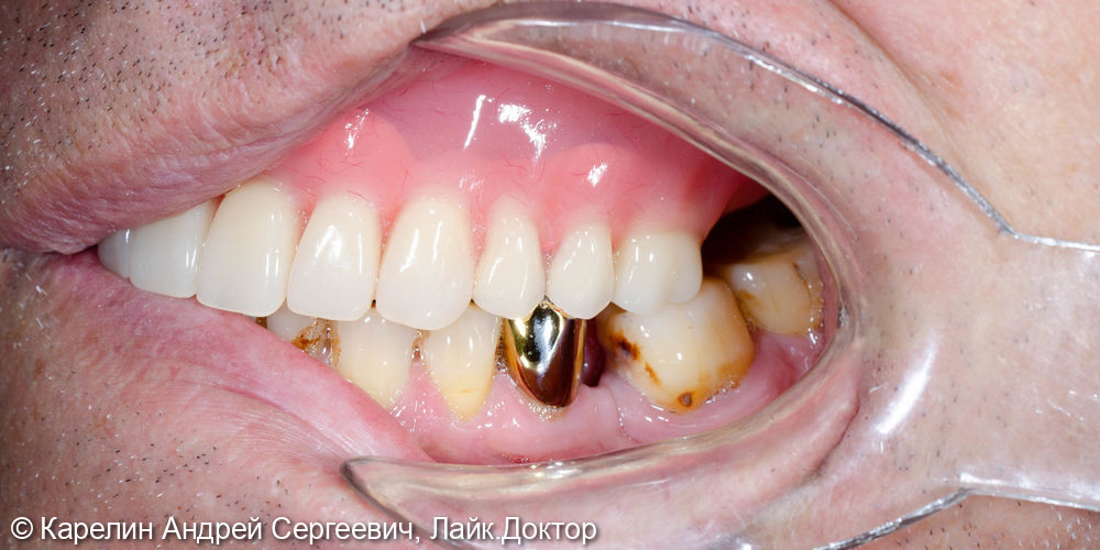 Протезирование при полном вторичном отсутствии зубов на верхней челюсти с помощью бюгельного протеза на имплантатах - фото №9