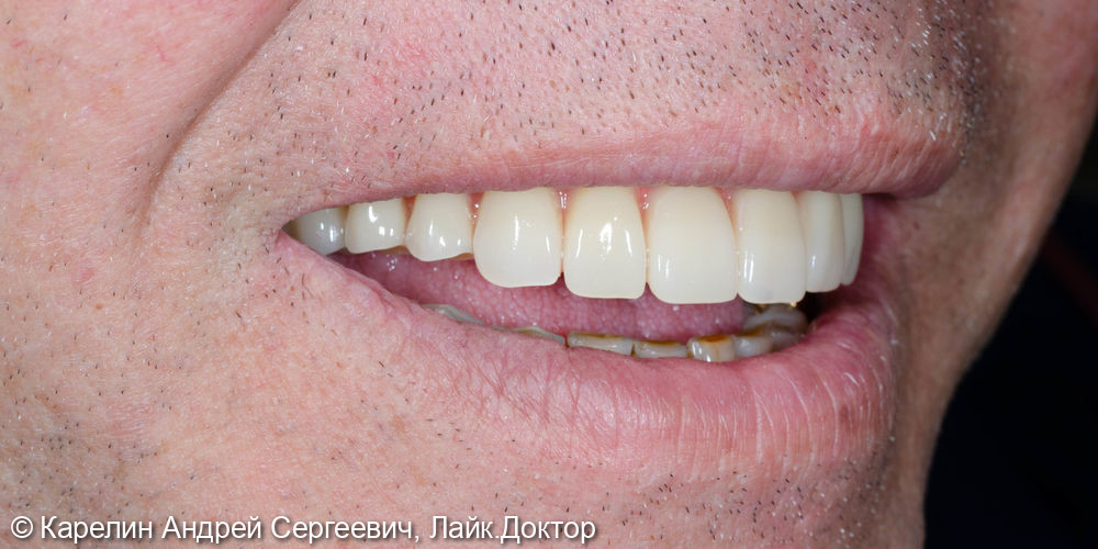 Протезирование при полном вторичном отсутствии зубов на верхней челюсти с помощью бюгельного протеза на имплантатах - фото №10