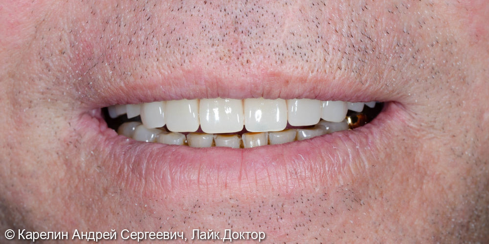 Протезирование при полном вторичном отсутствии зубов на верхней челюсти с помощью бюгельного протеза на имплантатах - фото №12