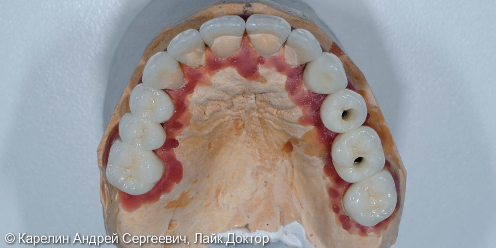Тотальное протезирование обеих челюстей с помощью имплантатов и безметалловых конструкций - фото №4