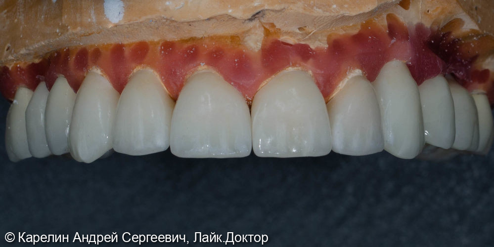 Тотальное протезирование обеих челюстей с помощью имплантатов и безметалловых конструкций - фото №5