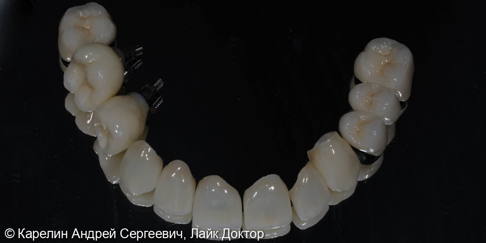 Тотальное протезирование обеих челюстей с помощью имплантатов и безметалловых конструкций - фото №6