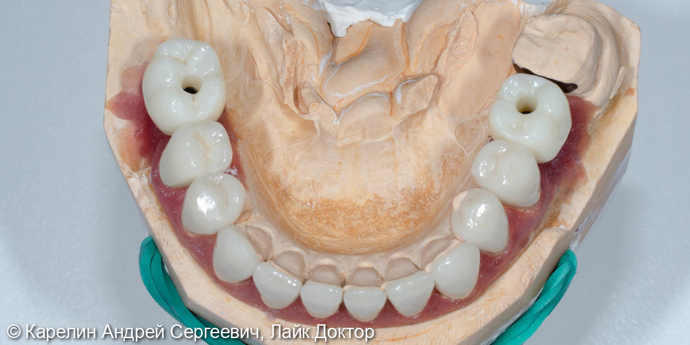 Тотальное протезирование обеих челюстей с помощью имплантатов и безметалловых конструкций - фото №7