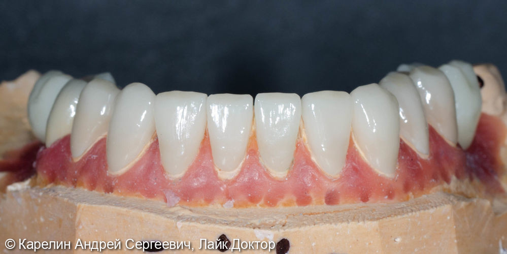 Тотальное протезирование обеих челюстей с помощью имплантатов и безметалловых конструкций - фото №8