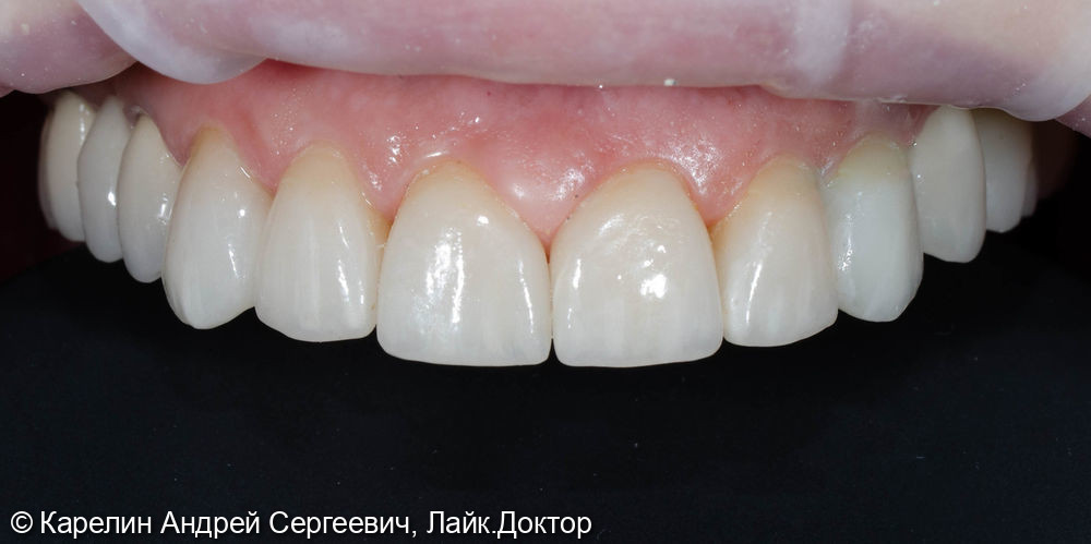 Тотальное протезирование обеих челюстей с помощью имплантатов и безметалловых конструкций - фото №10