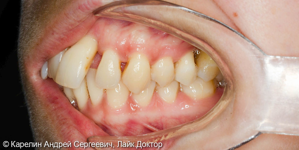 Имплантация и протезирование во фронтальном участке верхней челюсти - фото №3