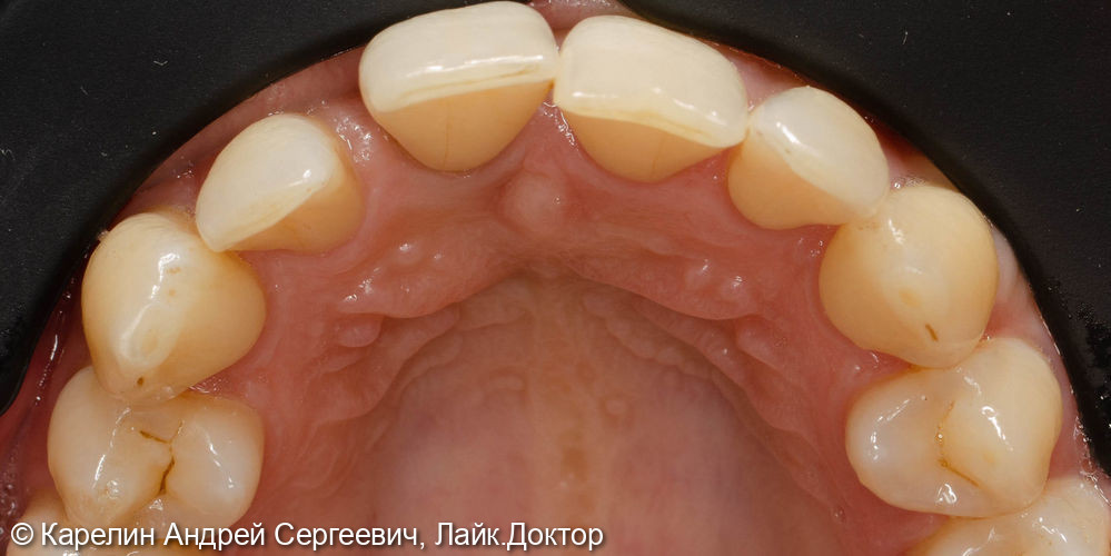 Имплантация и протезирование во фронтальном участке верхней челюсти - фото №5