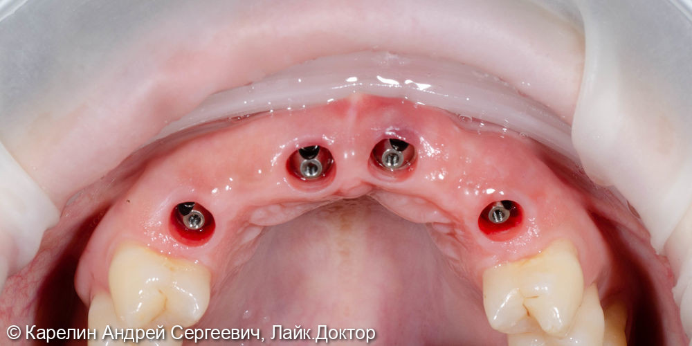 Имплантация и протезирование во фронтальном участке верхней челюсти - фото №8