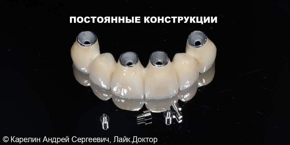 Имплантация и протезирование во фронтальном участке верхней челюсти - фото №13