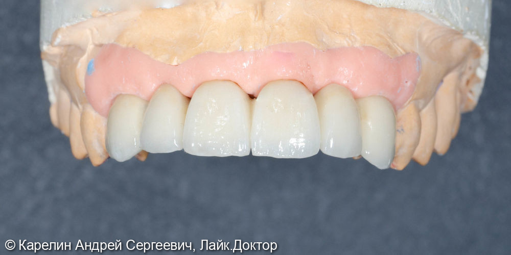 Имплантация и протезирование во фронтальном участке верхней челюсти - фото №14