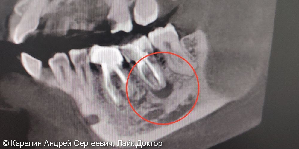 Лечение кисты зуба 3.7 - фото №1