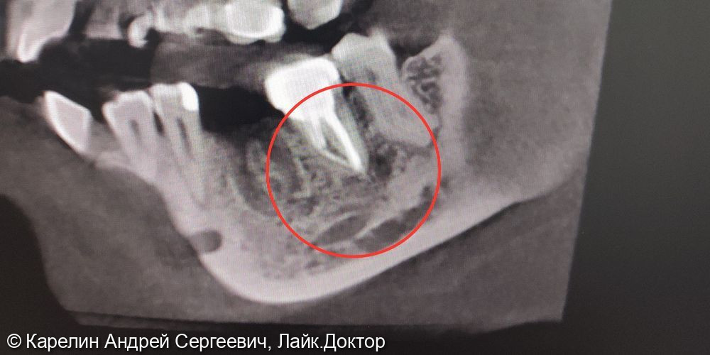 Лечение кисты зуба 3.7 - фото №2