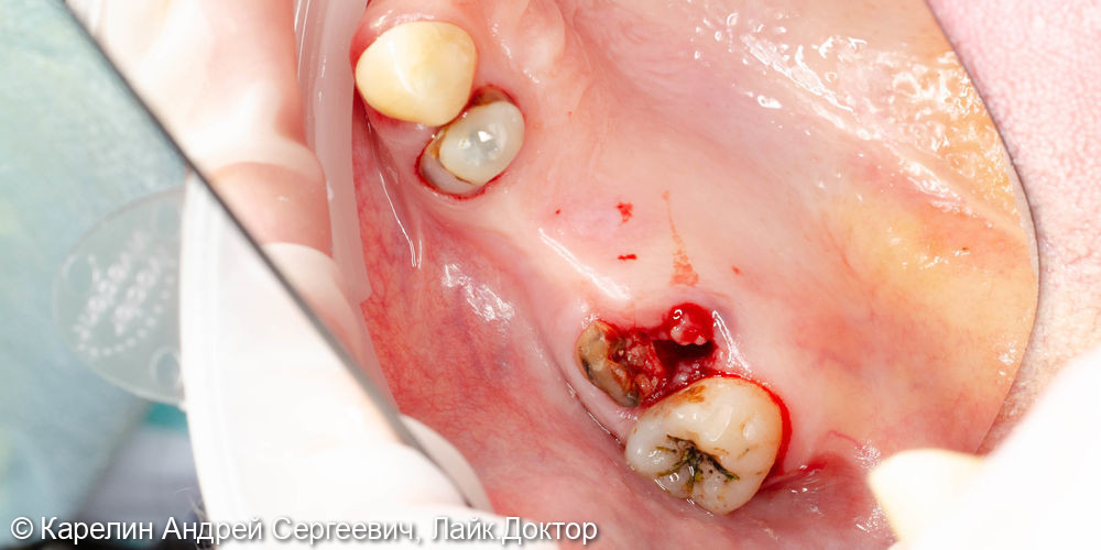 Установка имплантатов в области зубов 2.5,2.6,2.7 с одномоментным удалением зуба 2.7, и 2 костными пластиками - фото №1