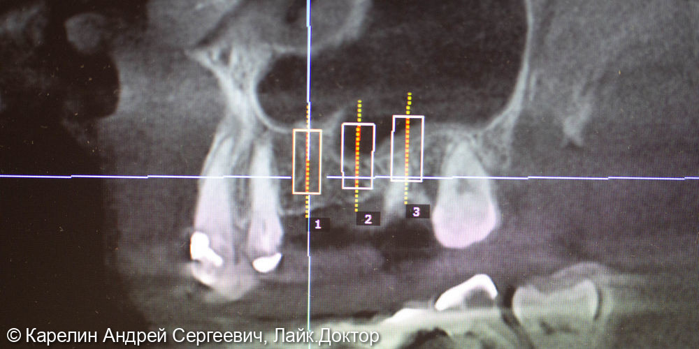 Установка имплантатов в области зубов 2.5,2.6,2.7 с одномоментным удалением зуба 2.7, и 2 костными пластиками - фото №2