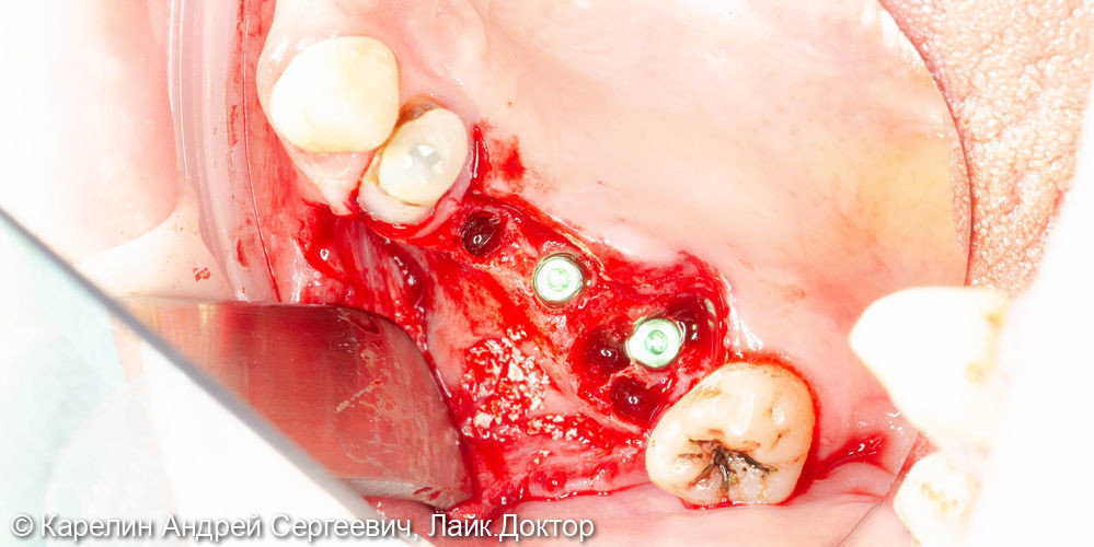 Установка имплантатов в области зубов 2.5,2.6,2.7 с одномоментным удалением зуба 2.7, и 2 костными пластиками - фото №5