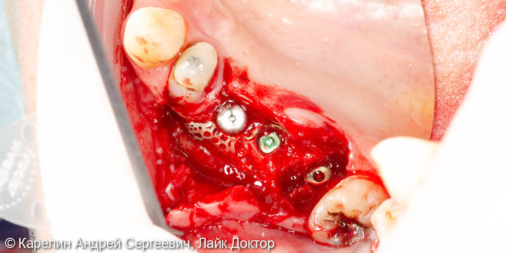 Установка имплантатов в области зубов 2.5,2.6,2.7 с одномоментным удалением зуба 2.7, и 2 костными пластиками - фото №6