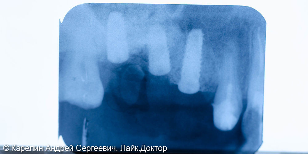 Установка имплантатов в области зубов 2.5,2.6,2.7 с одномоментным удалением зуба 2.7, и 2 костными пластиками - фото №7