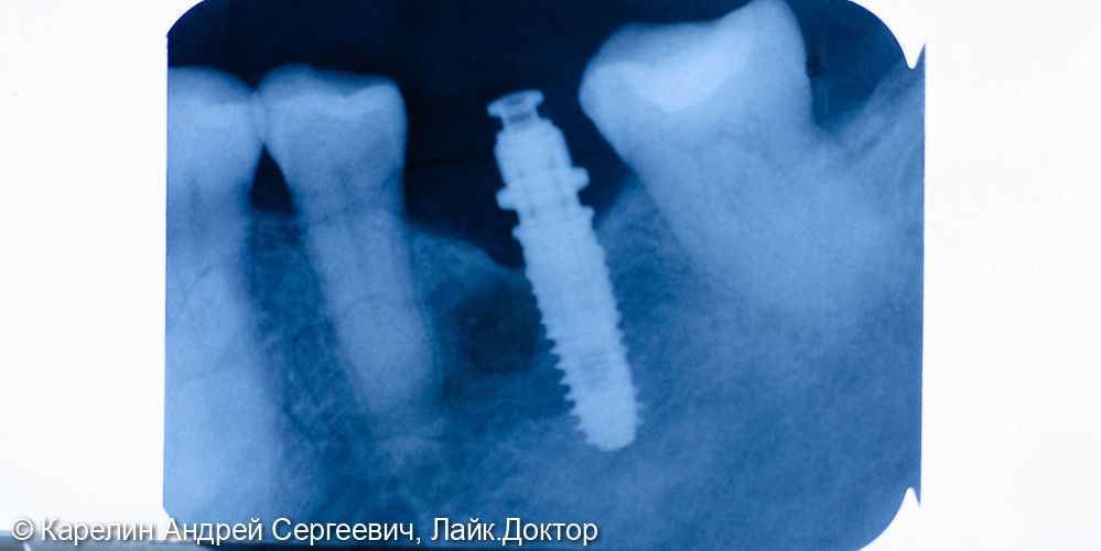 Имплантация в жевательном отделе нижней челюсти и операция по формированию преддверия - фото №4