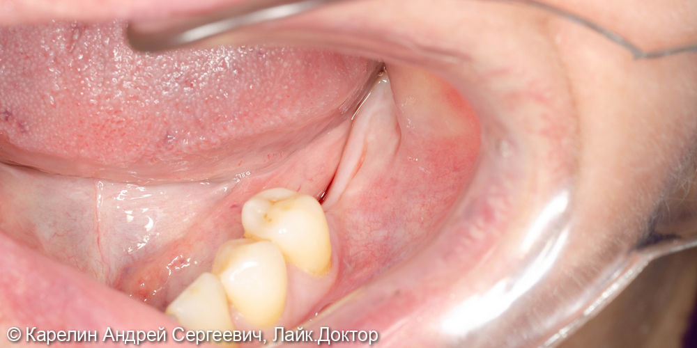 Имплантация в жевательном отделе нижней челюсти и операция по формированию преддверия - фото №6