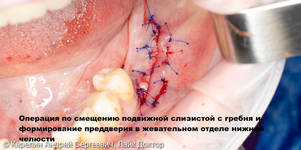 Имплантация в жевательном отделе нижней челюсти и операция по формированию преддверия - фото №5
