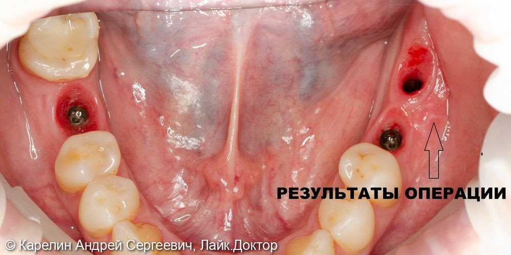 Имплантация в жевательном отделе нижней челюсти и операция по формированию преддверия - фото №9