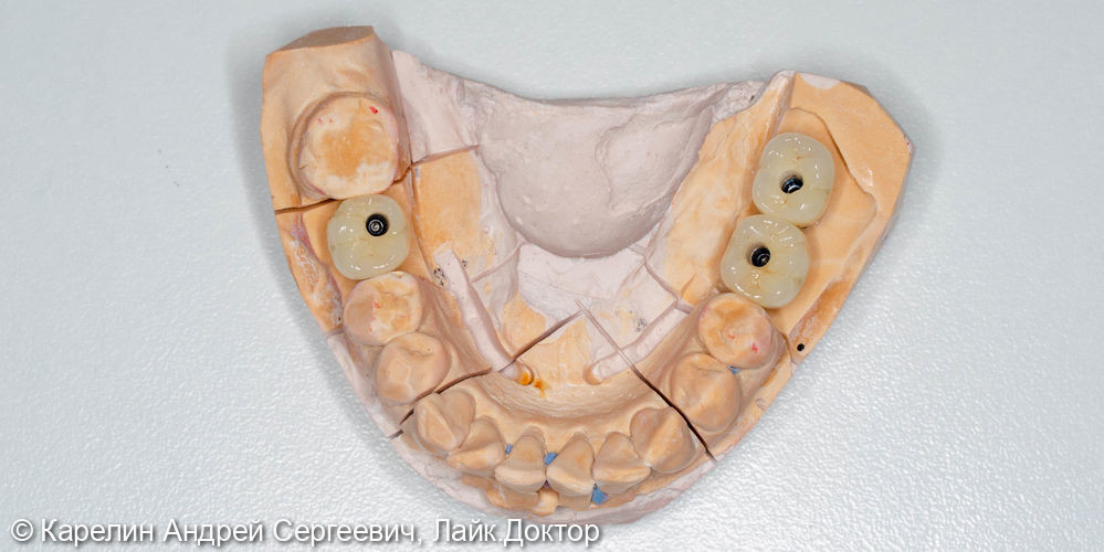 Имплантация в жевательном отделе нижней челюсти и операция по формированию преддверия - фото №10