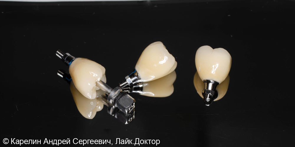 Имплантация в жевательном отделе нижней челюсти и операция по формированию преддверия - фото №11