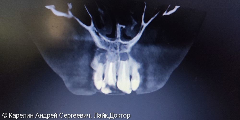 Эстетическая реабилитация фронтального участка верхней челюсти с помощью имплантатов - фото №2
