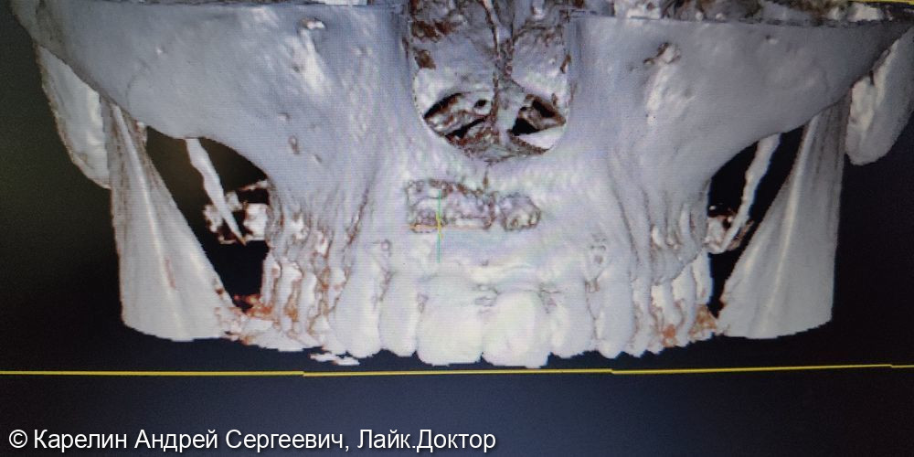 Эстетическая реабилитация фронтального участка верхней челюсти с помощью имплантатов - фото №3